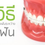5วิธีดูแลสุขภาพฟันระหว่างจัดฟัน