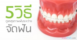 5วิธีดูแลสุขภาพฟันระหว่างจัดฟัน