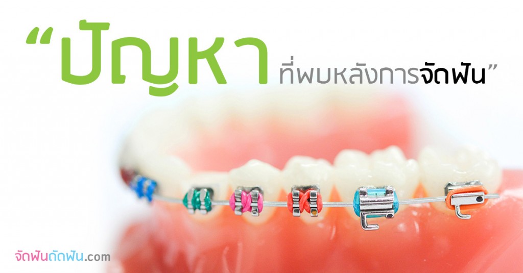 ปัญหาที่พบหลังการจัดฟัน