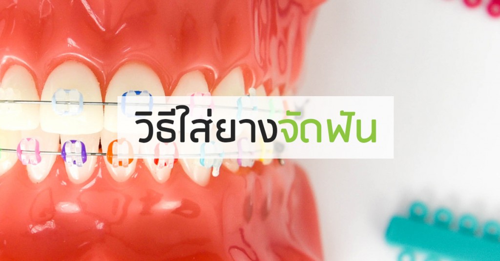 วิธีใส่ยางจัดฟัน